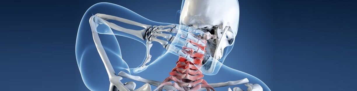 Osteochondrosis an spine ceirbheacsach daonna