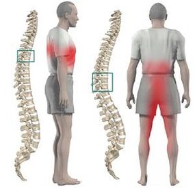 Is féidir pian le chondrosis chliabhraigh a thabhairt do na géaga íochtaracha agus don crotch