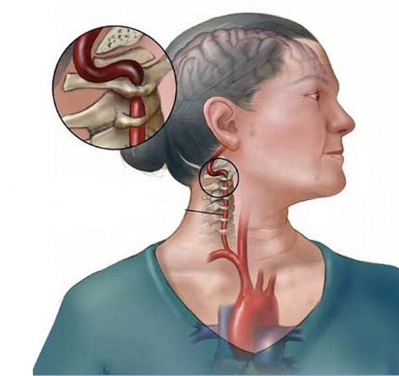 siondróm artaire veirteabrach le osteochondrosis ceirbheacsach