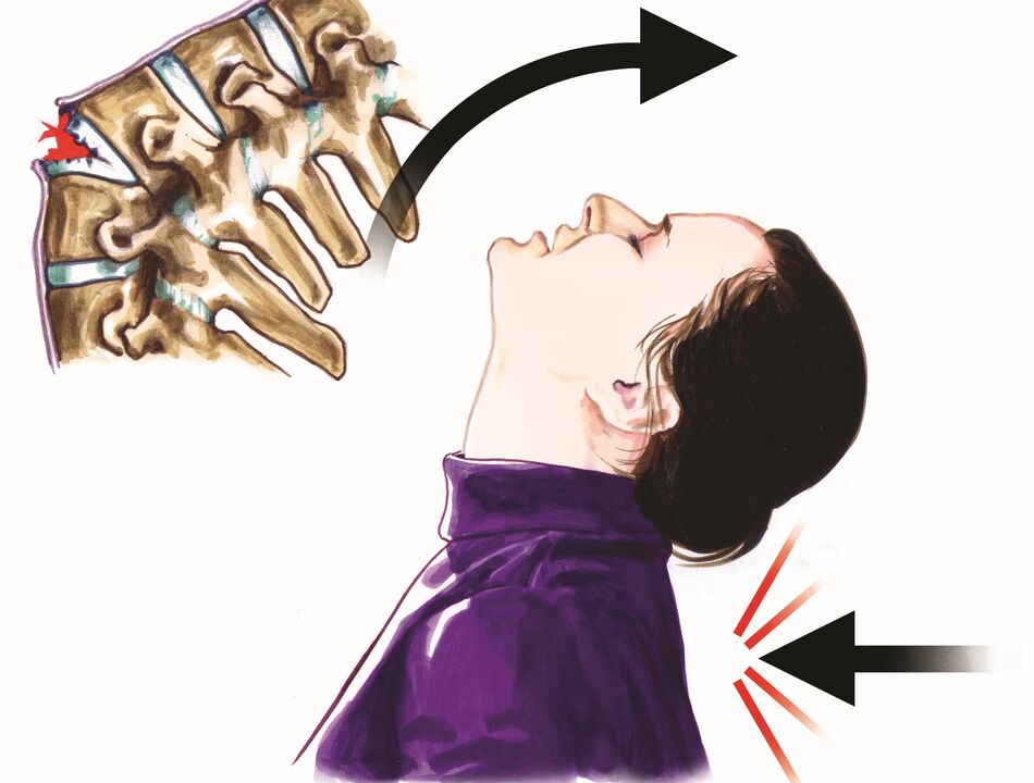 damáiste dromlaigh mar chúis le pian muineál